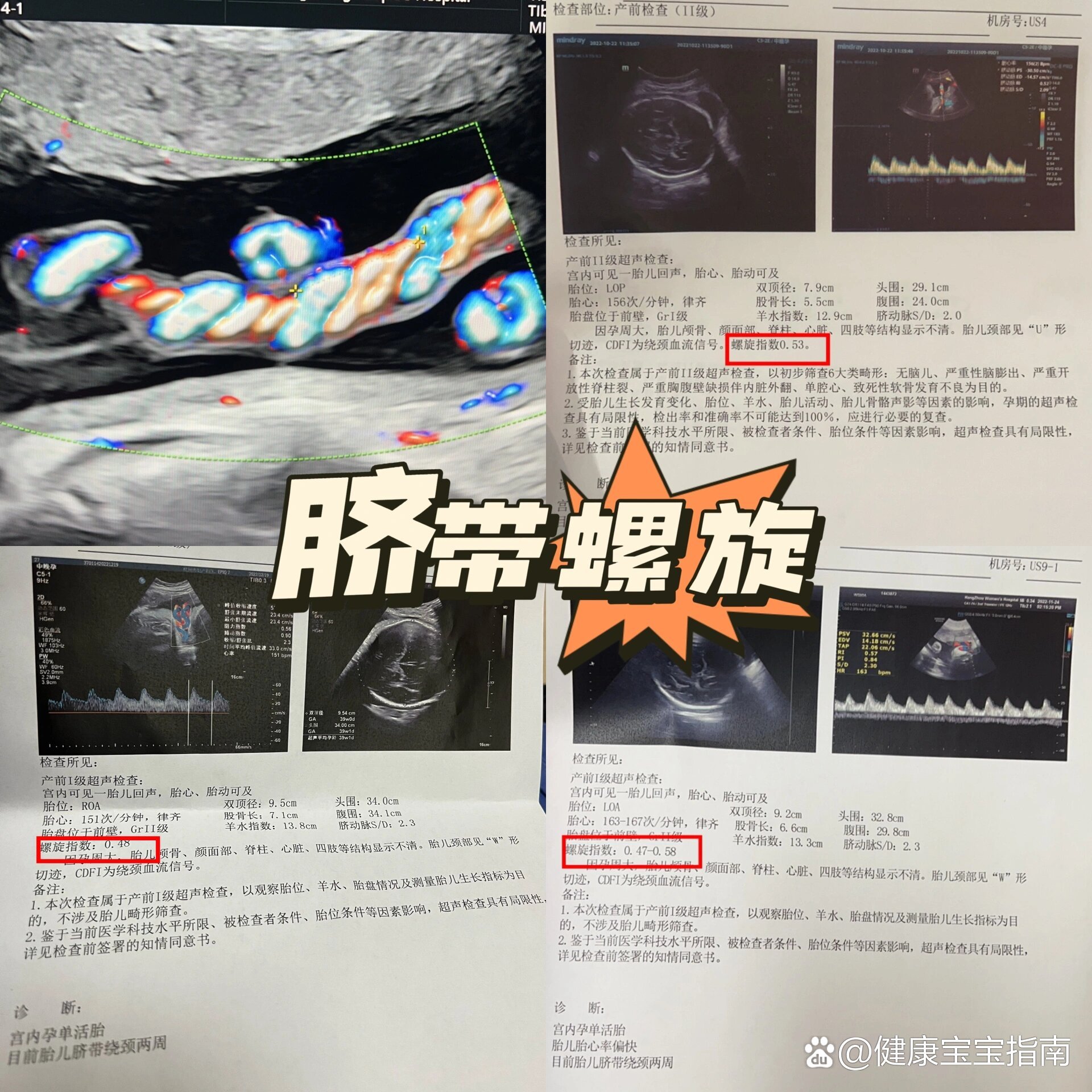 6315 br>脐带螺旋指数高,已顺利产下5.8斤男宝?