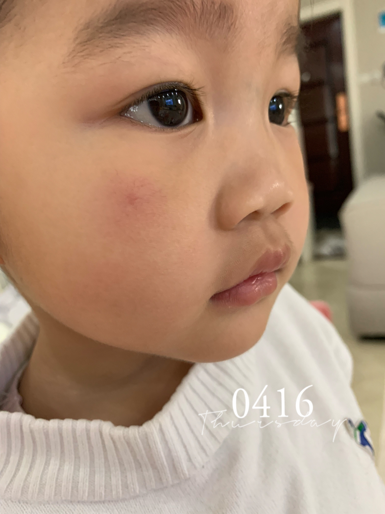 儿童蜘蛛痣