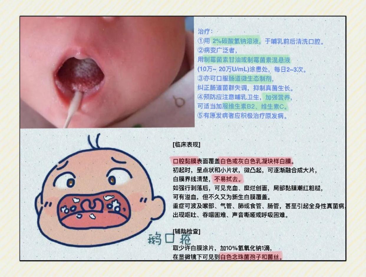 👶鹅口疮患儿的门诊日常碎片记录