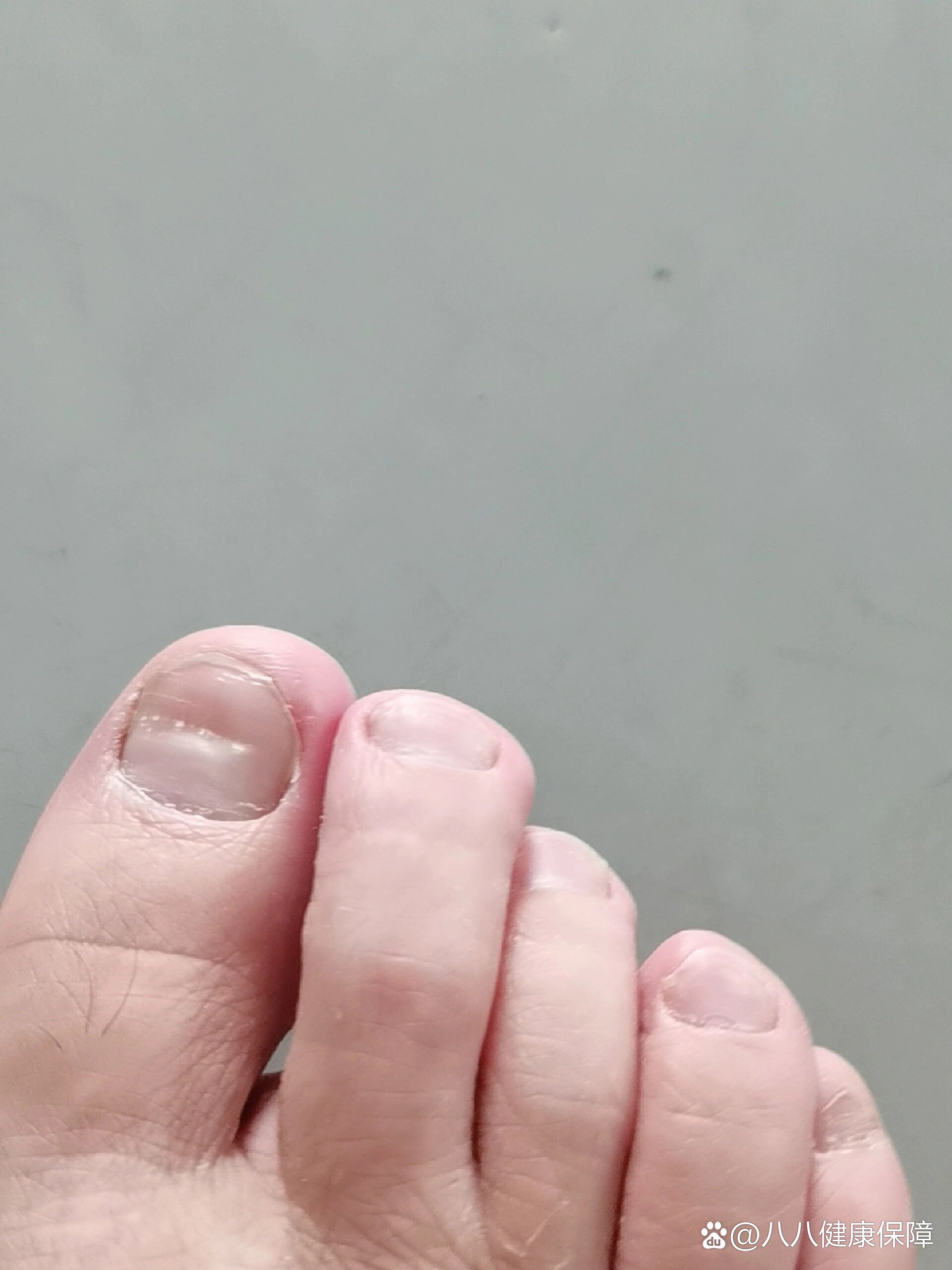 大脚趾头凹凸不平是什么原因啊