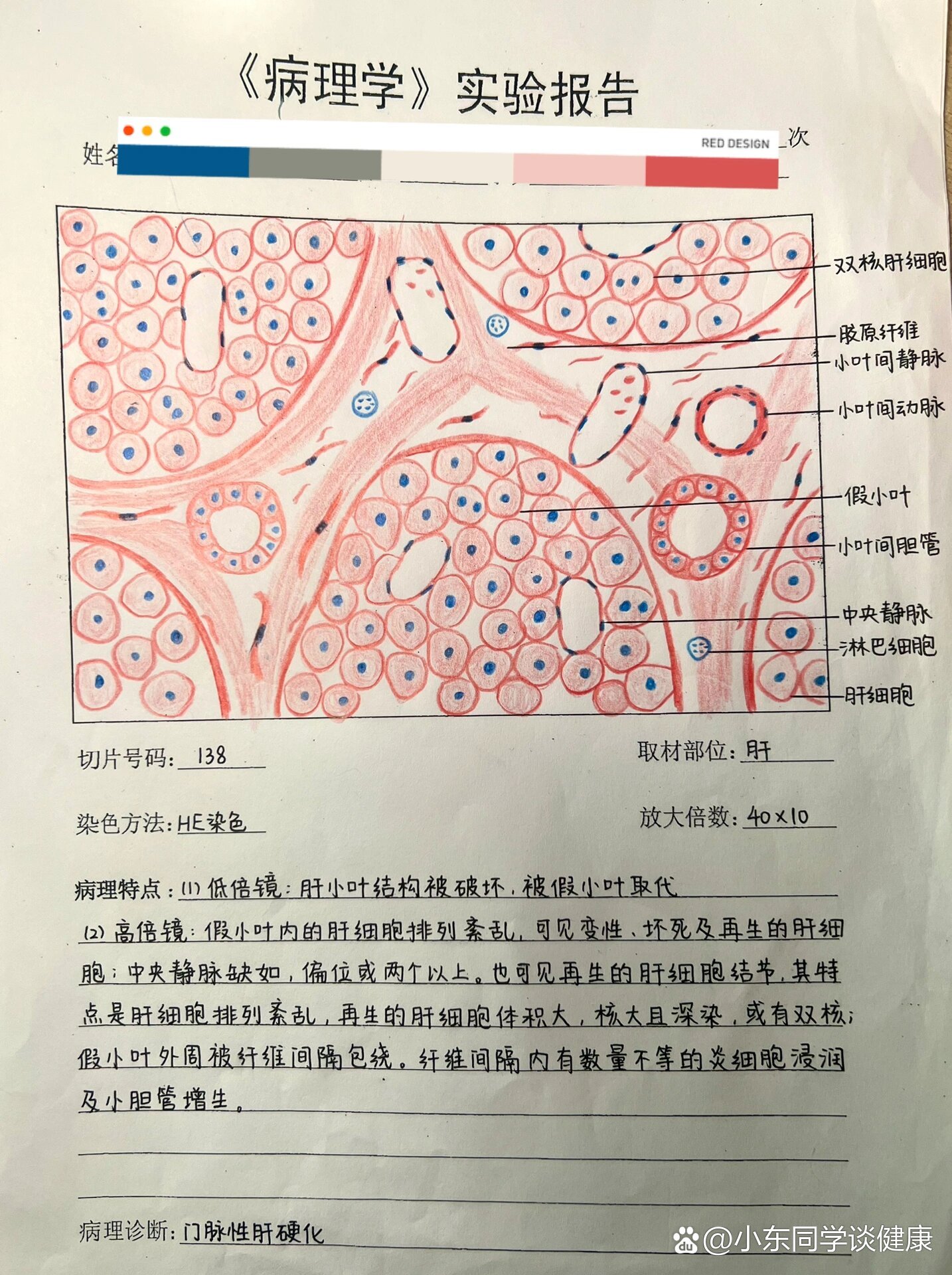 08病理学实验报告56615门脉性肝硬化