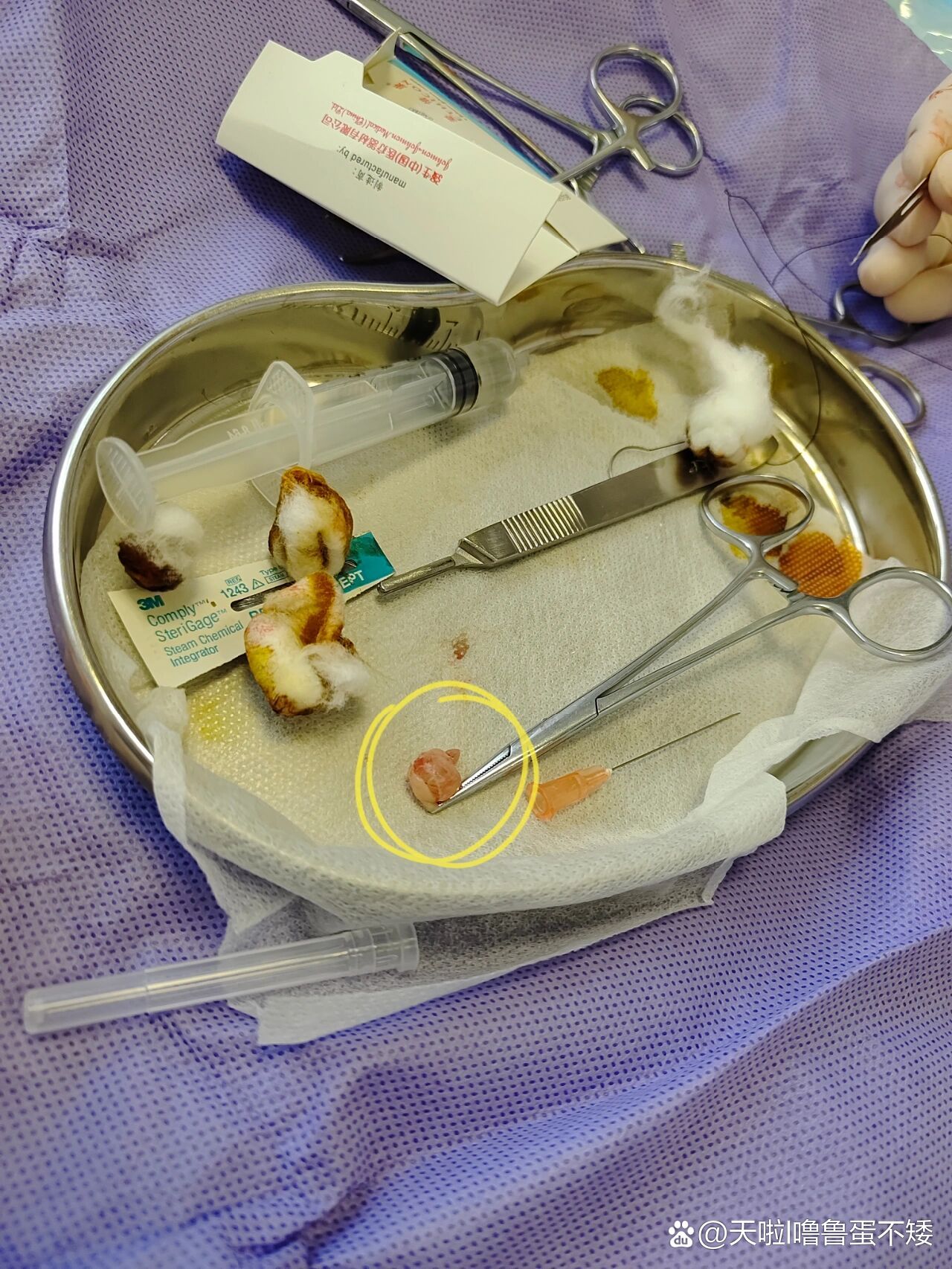 (治愈日记)终于下定决定切了粘液腺囊肿