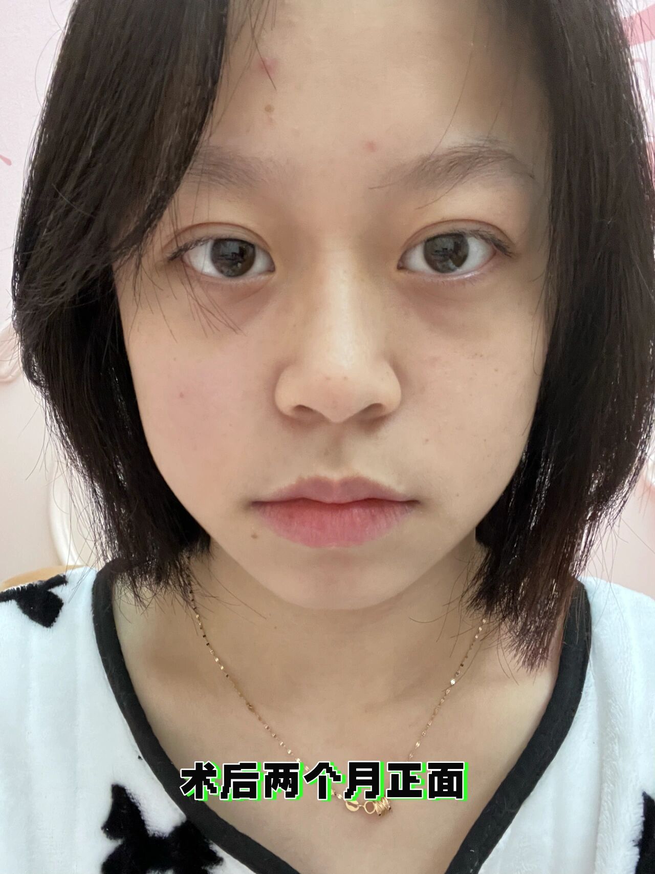 眼眶减压手术术后分享|真的回退了很多!