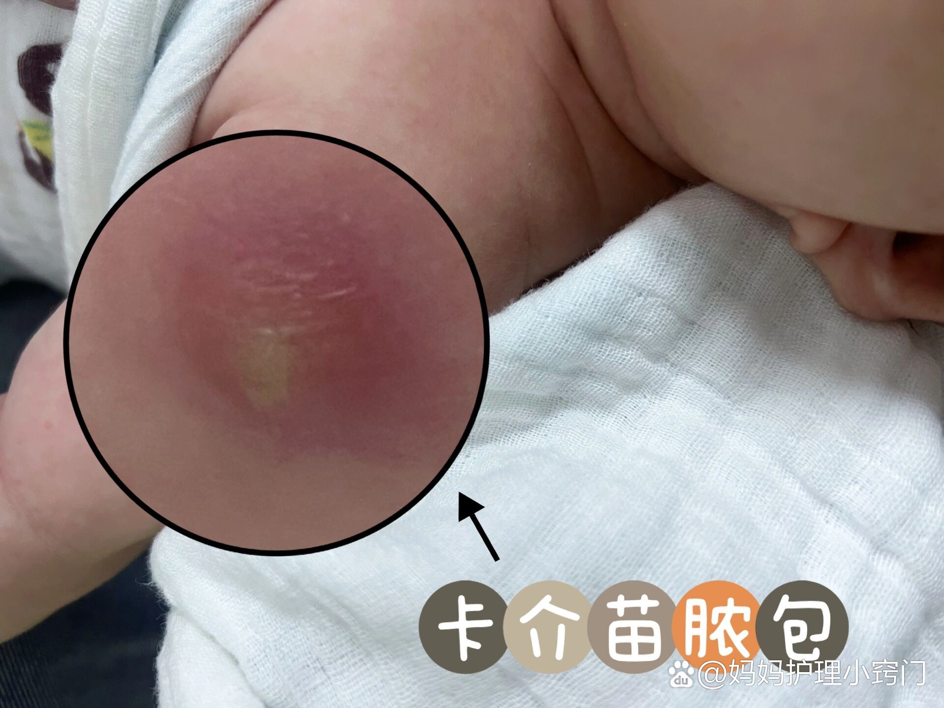 新手妈妈不要慌,宝宝左胳膊突然发现脓包❗