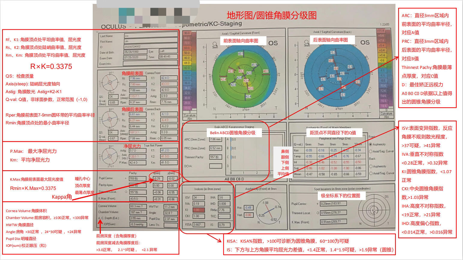 教你如何快速看懂角膜地形图报告