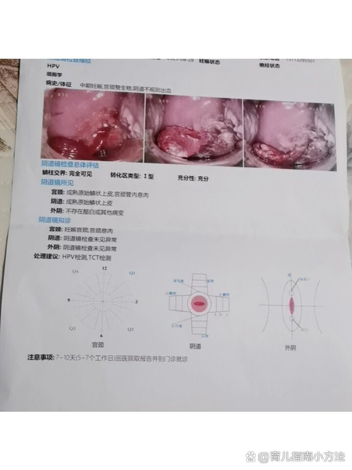 宫颈息肉图片 清晰图片