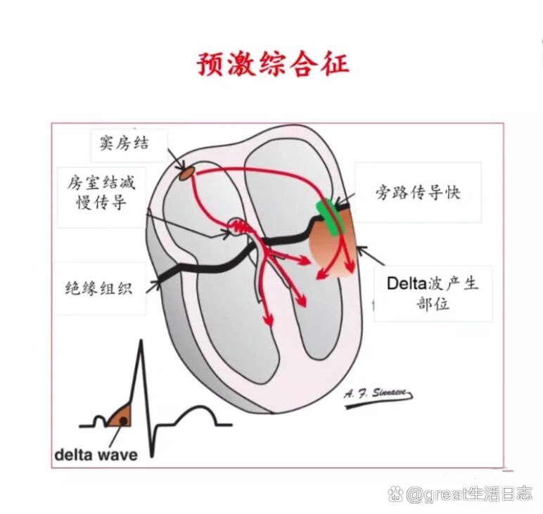 心室预激波心电图特点图片