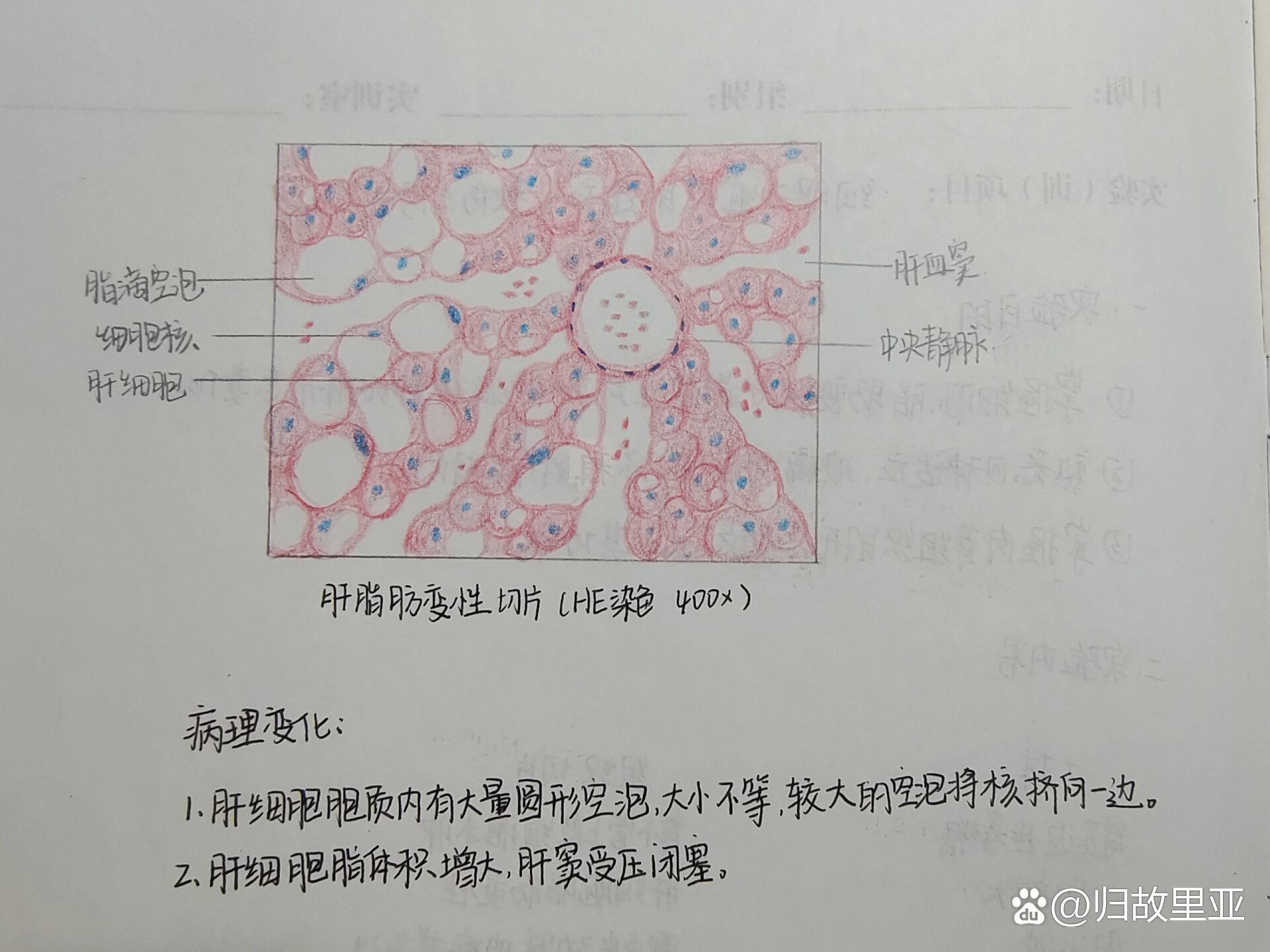 肝细胞癌红蓝铅笔图图片