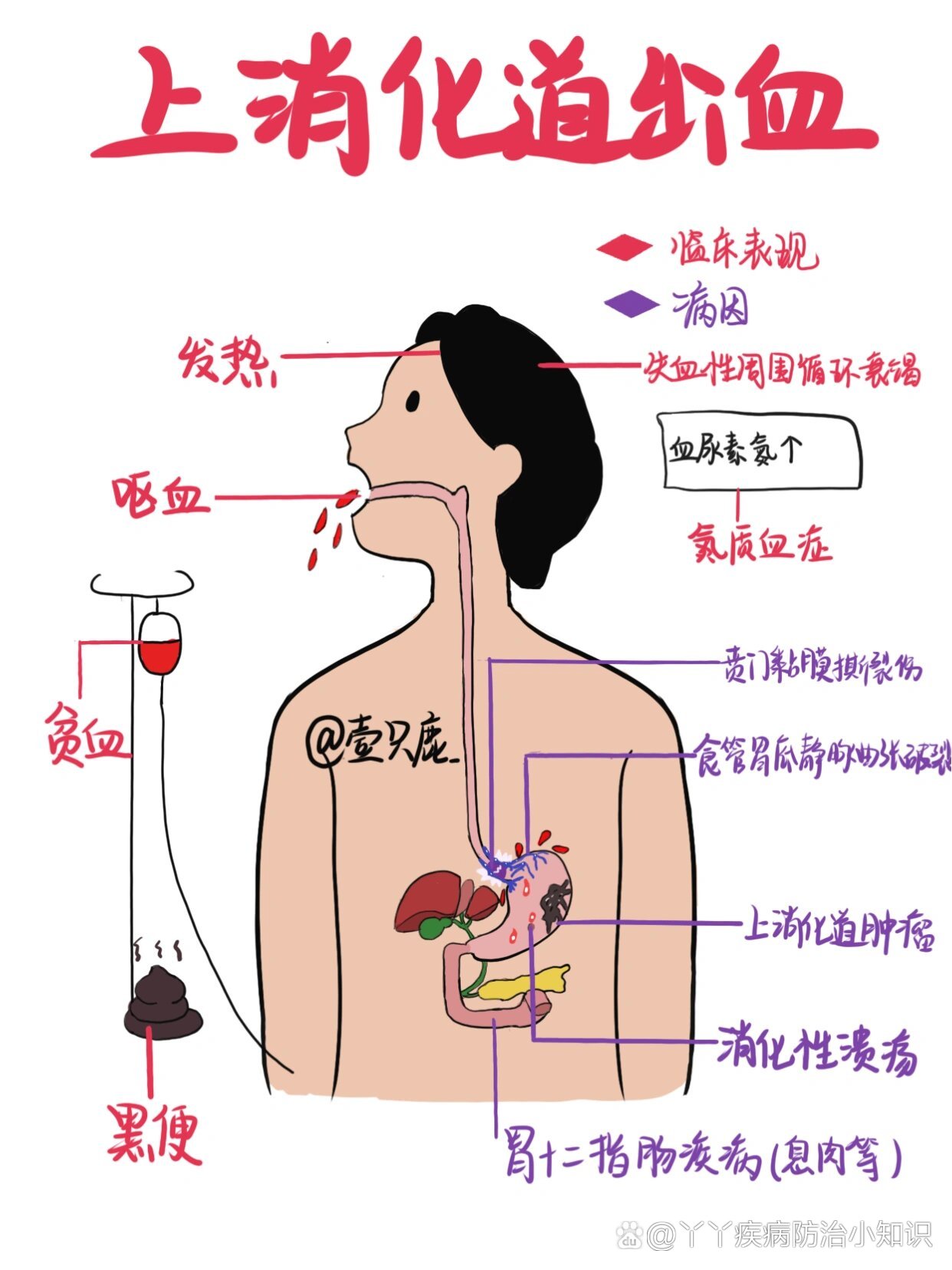 消化道出血卡通图片