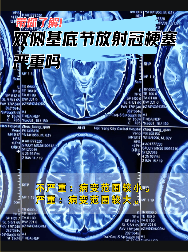 基底节区 放射冠图片