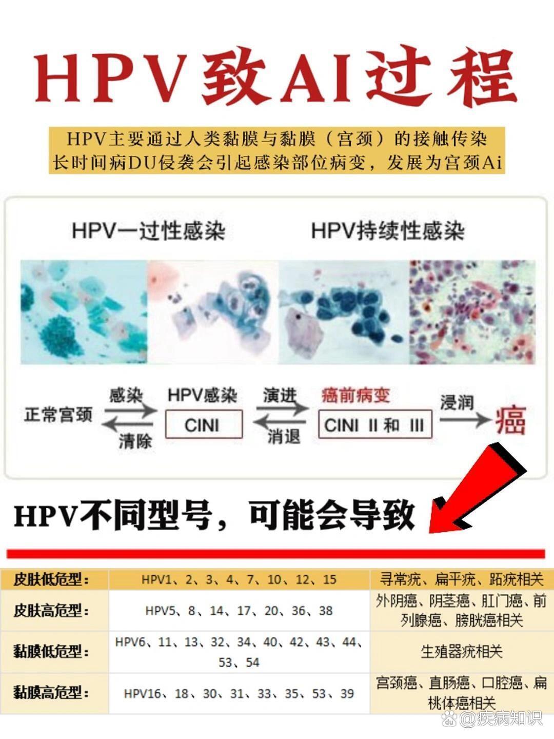 HPV感染致Ai的过程，会经历这5个阶段