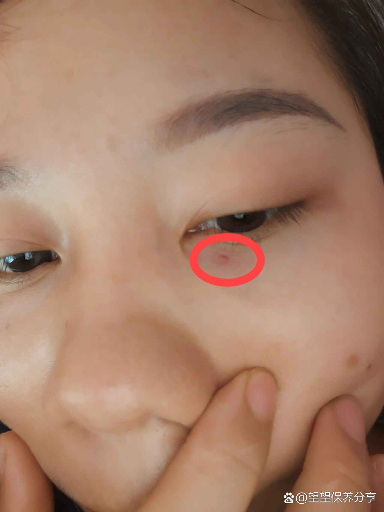 眼睛下面长小红点,请问各位有什么好的法子消除掉吗?