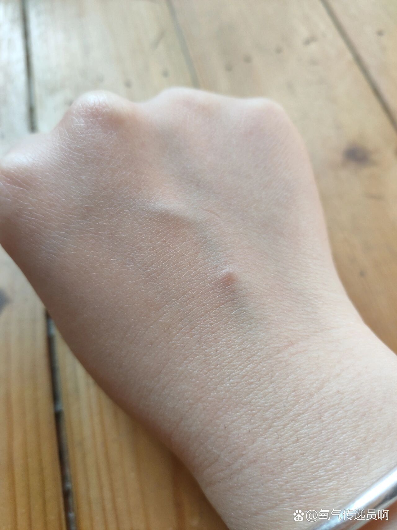 打完吊瓶以后有个小鼓包一直没消是咋回事呀