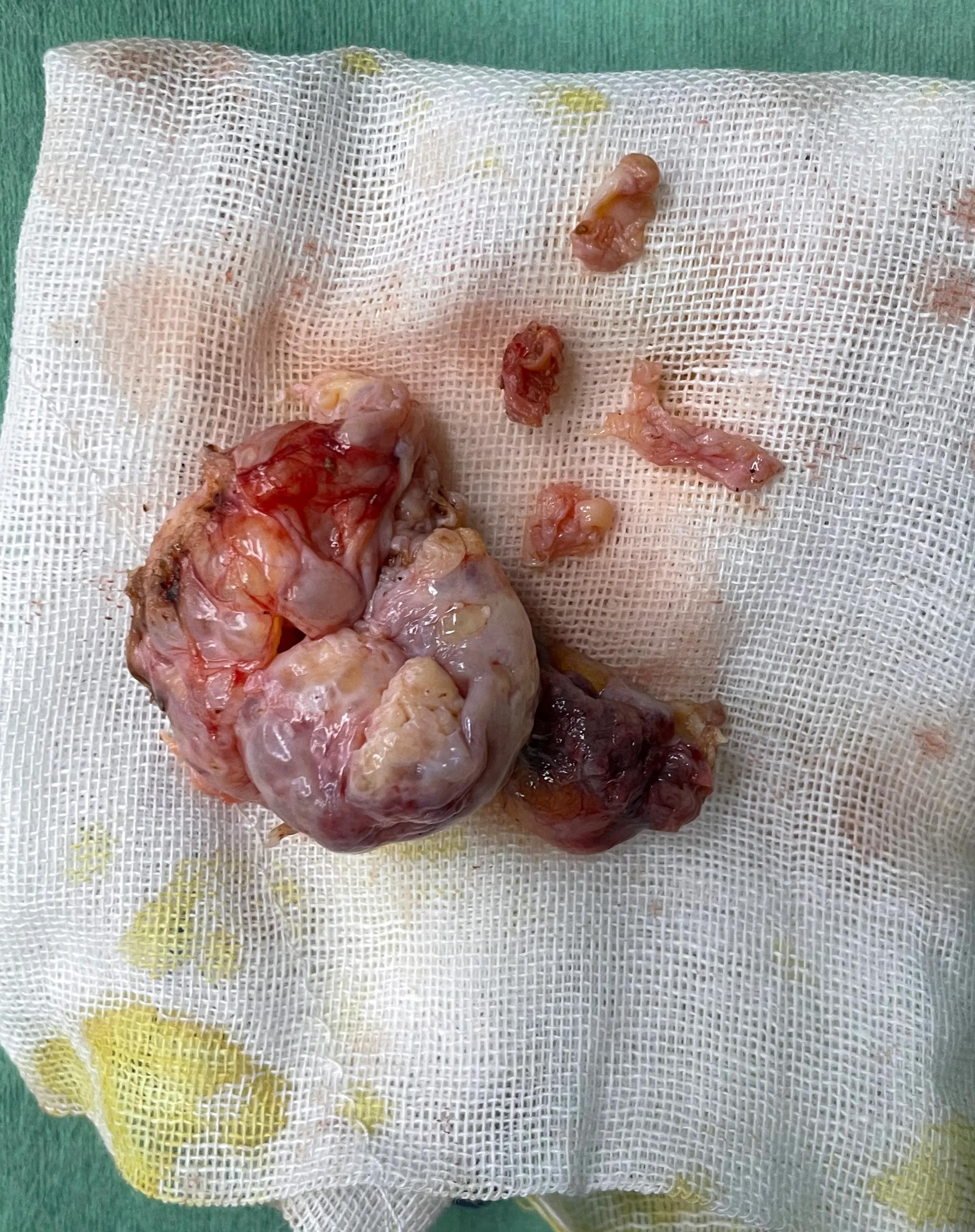 #妇科龙医生科普#子宫全切术后保留卵巢的风险就是卵巢肿物<br