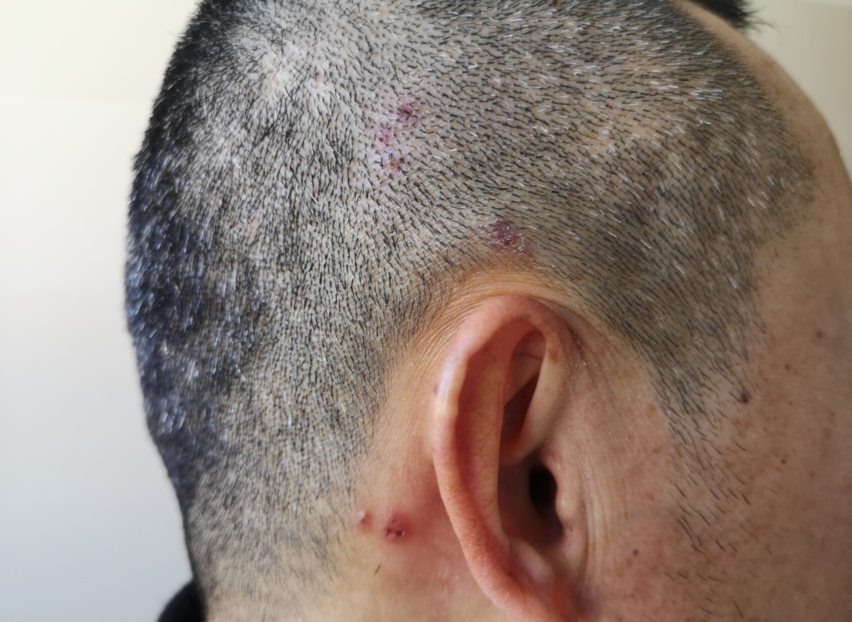 头上长的是带状疱疹!