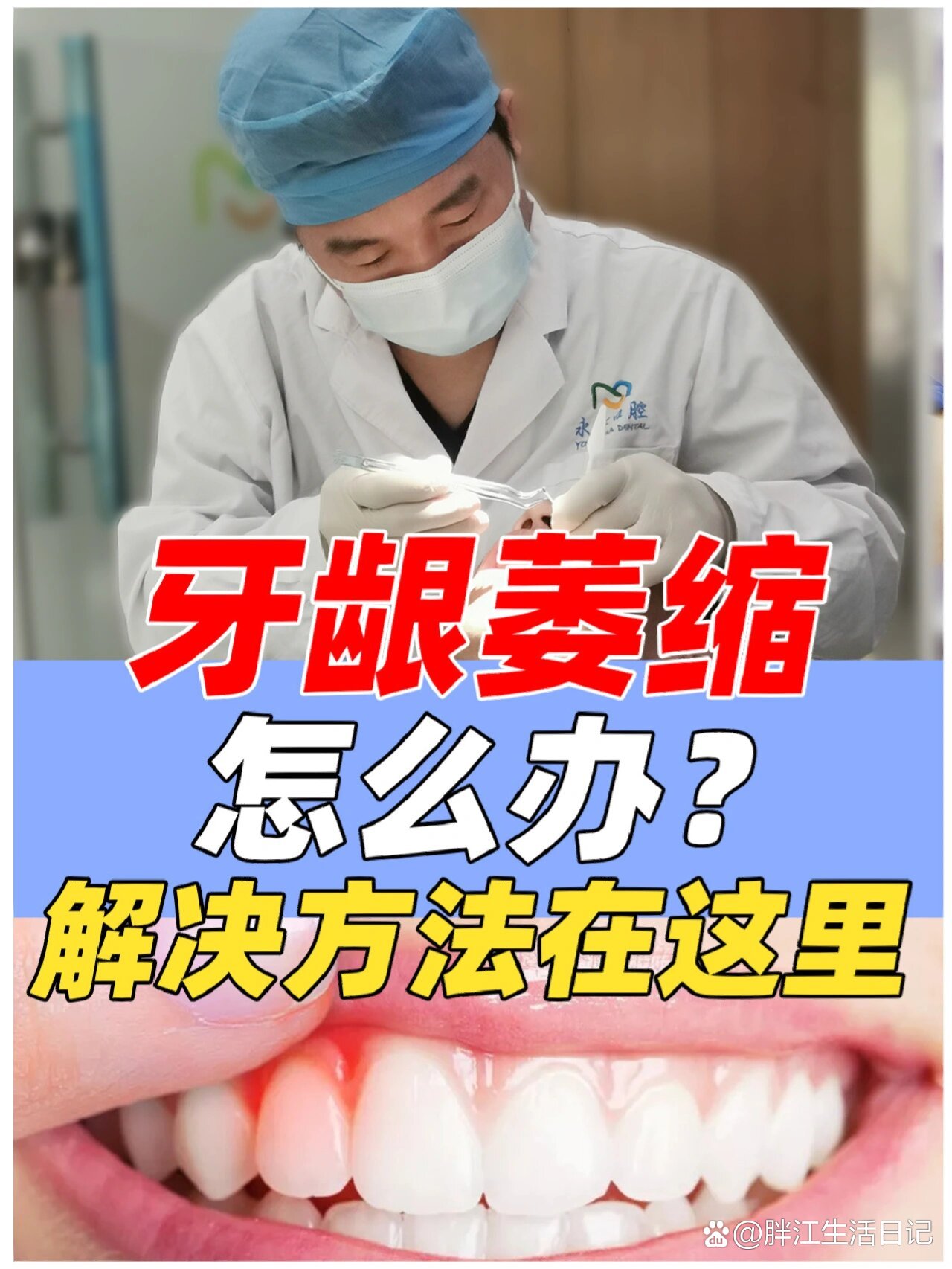 牙龈萎缩怎么回事图片