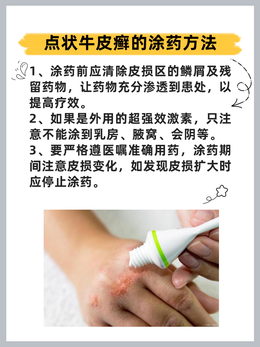 点状牛皮癣的治疗原来这么简单!