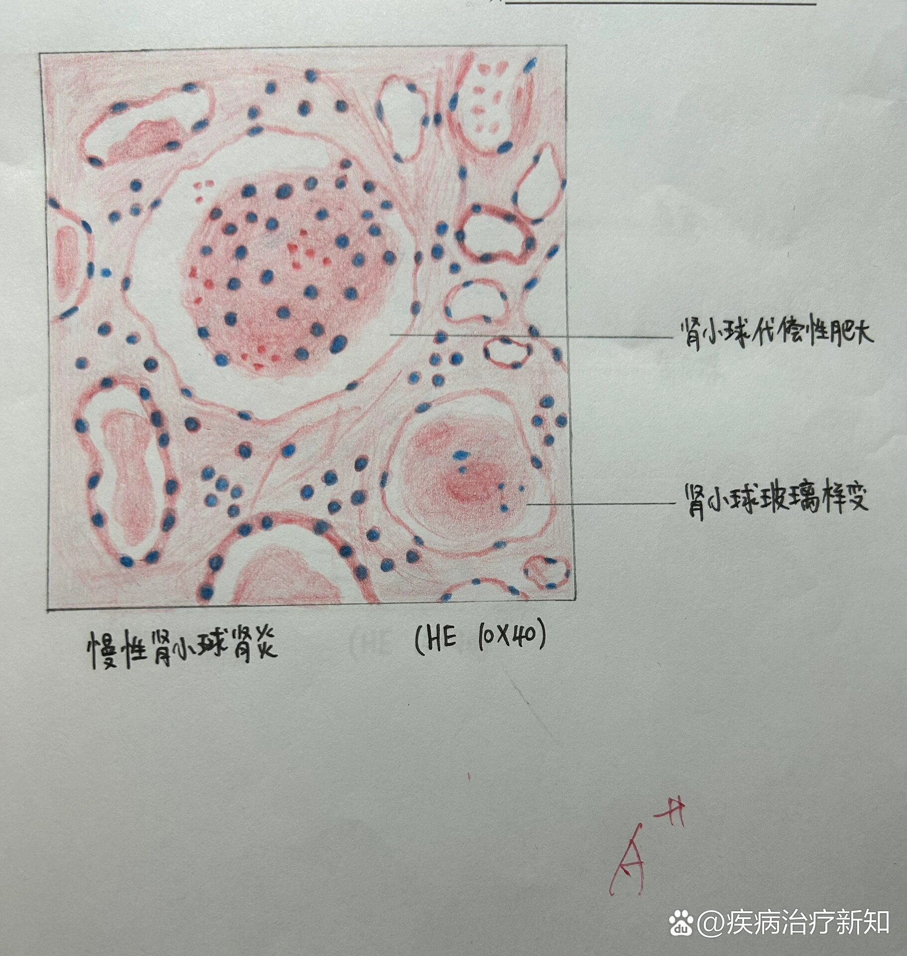 切片绘画图1慢性肾小球肾炎图2风湿性