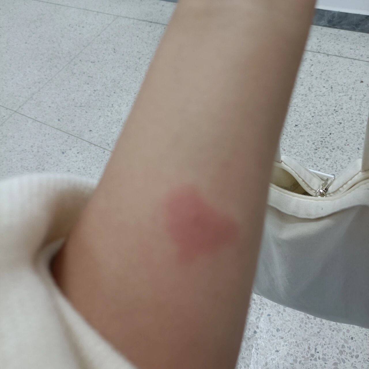 ppd皮试24小时后