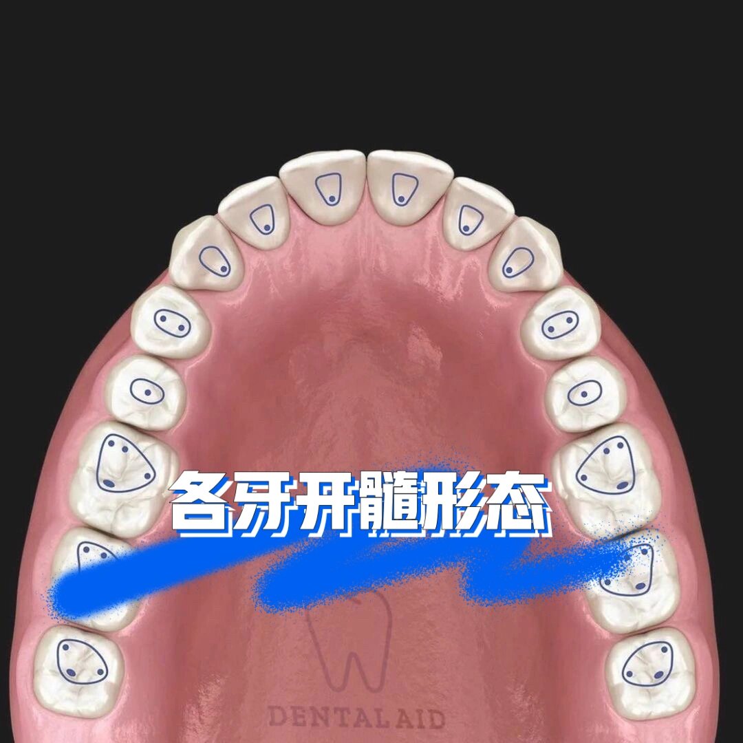 下颌中切牙髓腔形态图片