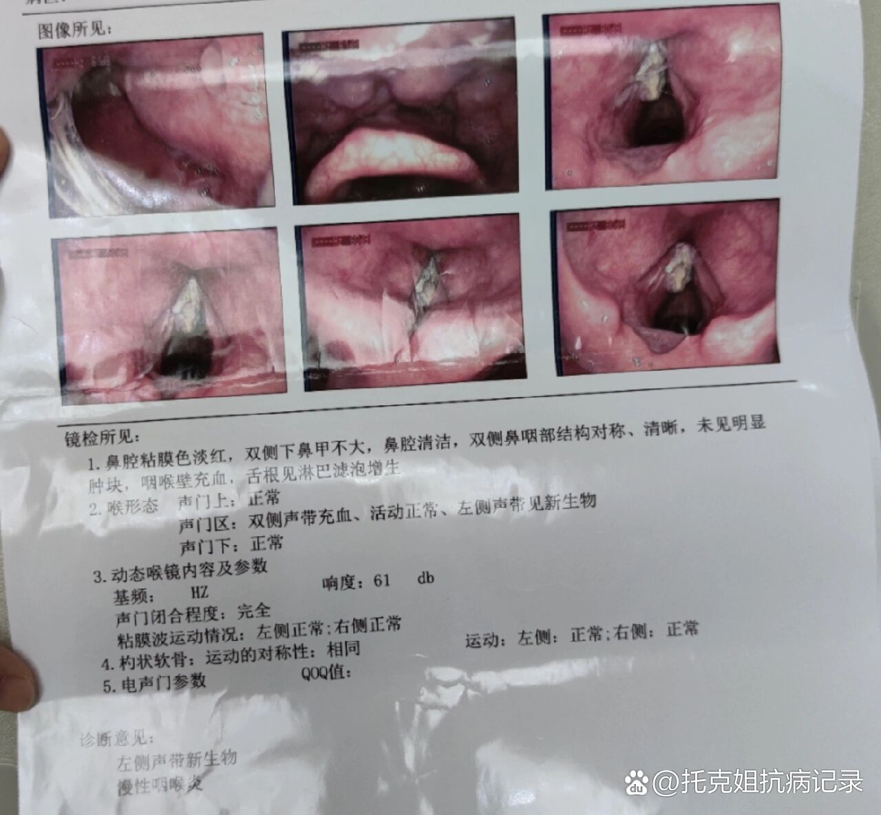 喉癌和咽炎的区别图片图片