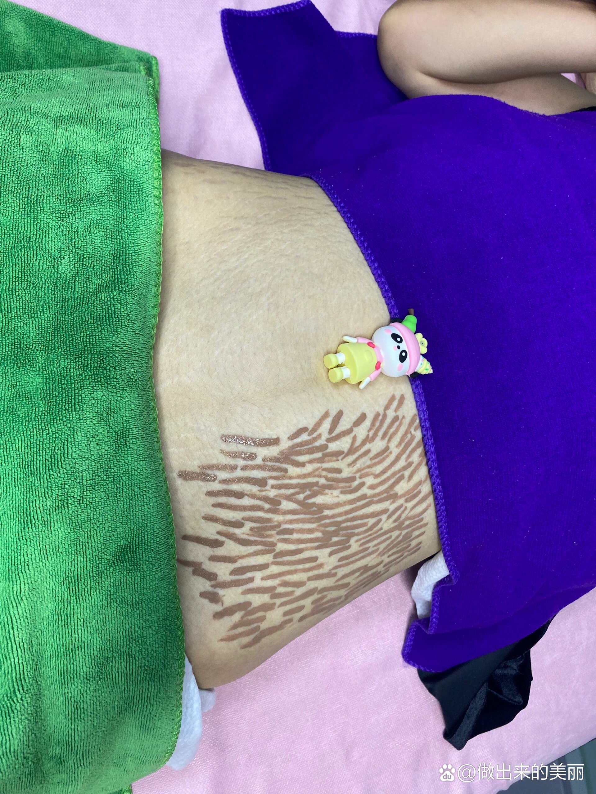 肤色重建术淡化妊娠纹真的靠谱吗?