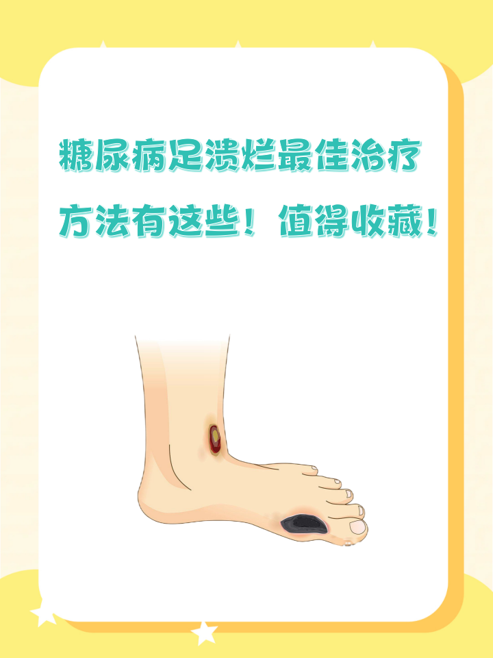 糖尿病足溃烂最佳治疗方法有这些!值得收藏!