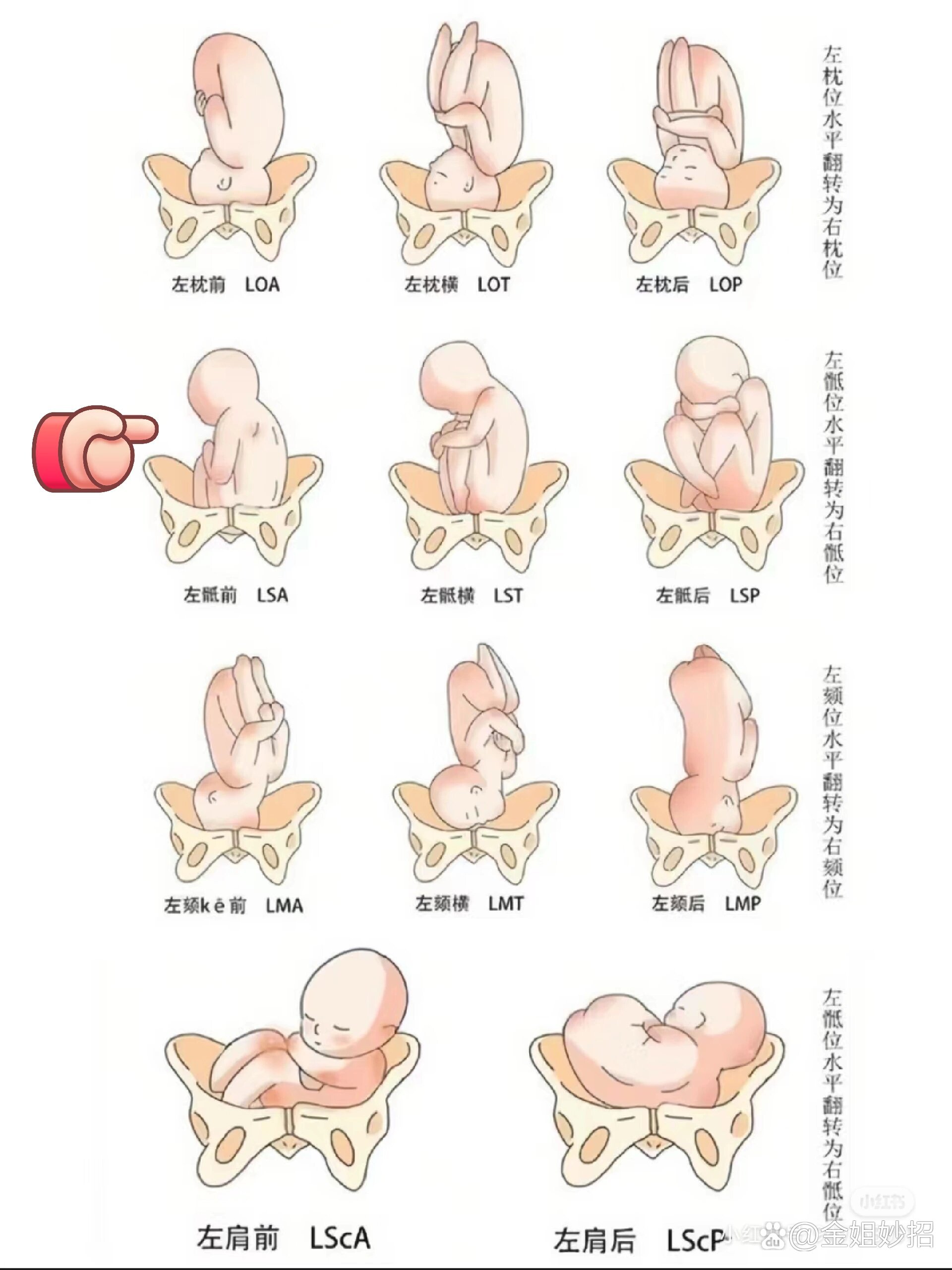 36周 2还是臀位怎么办