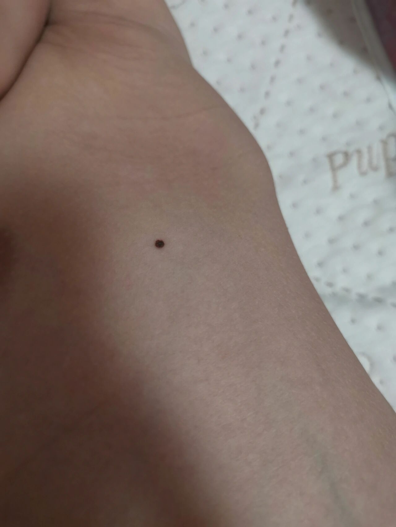 宝宝腋下这个痣要紧吗