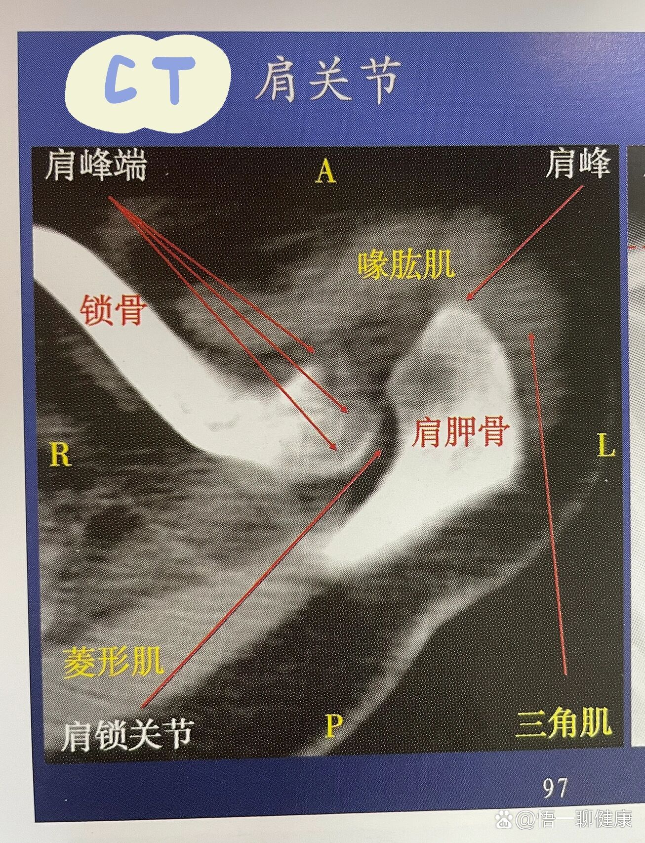 ct之肩关节横断面解剖