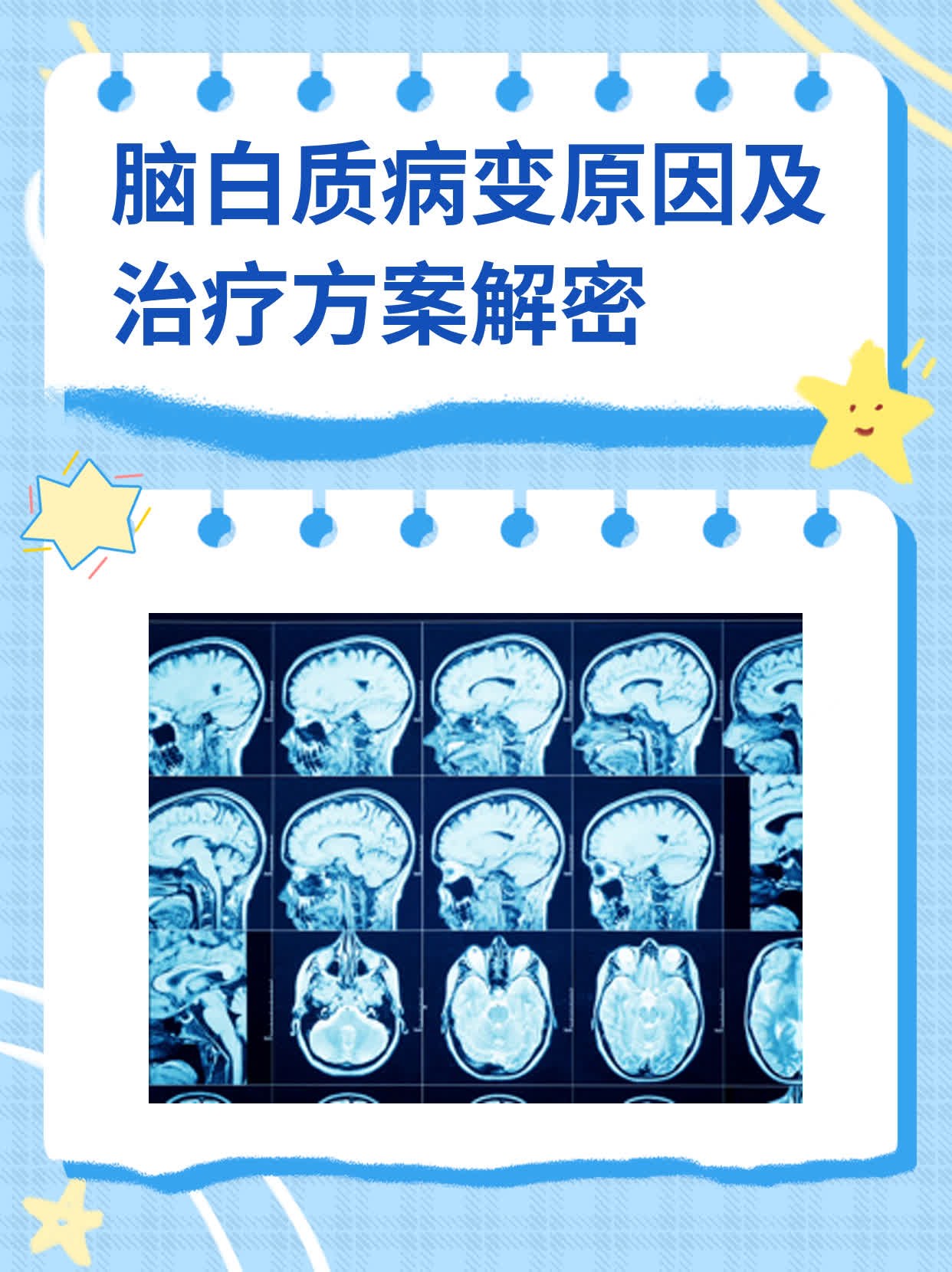 脑白质病变原因及治疗方案解密