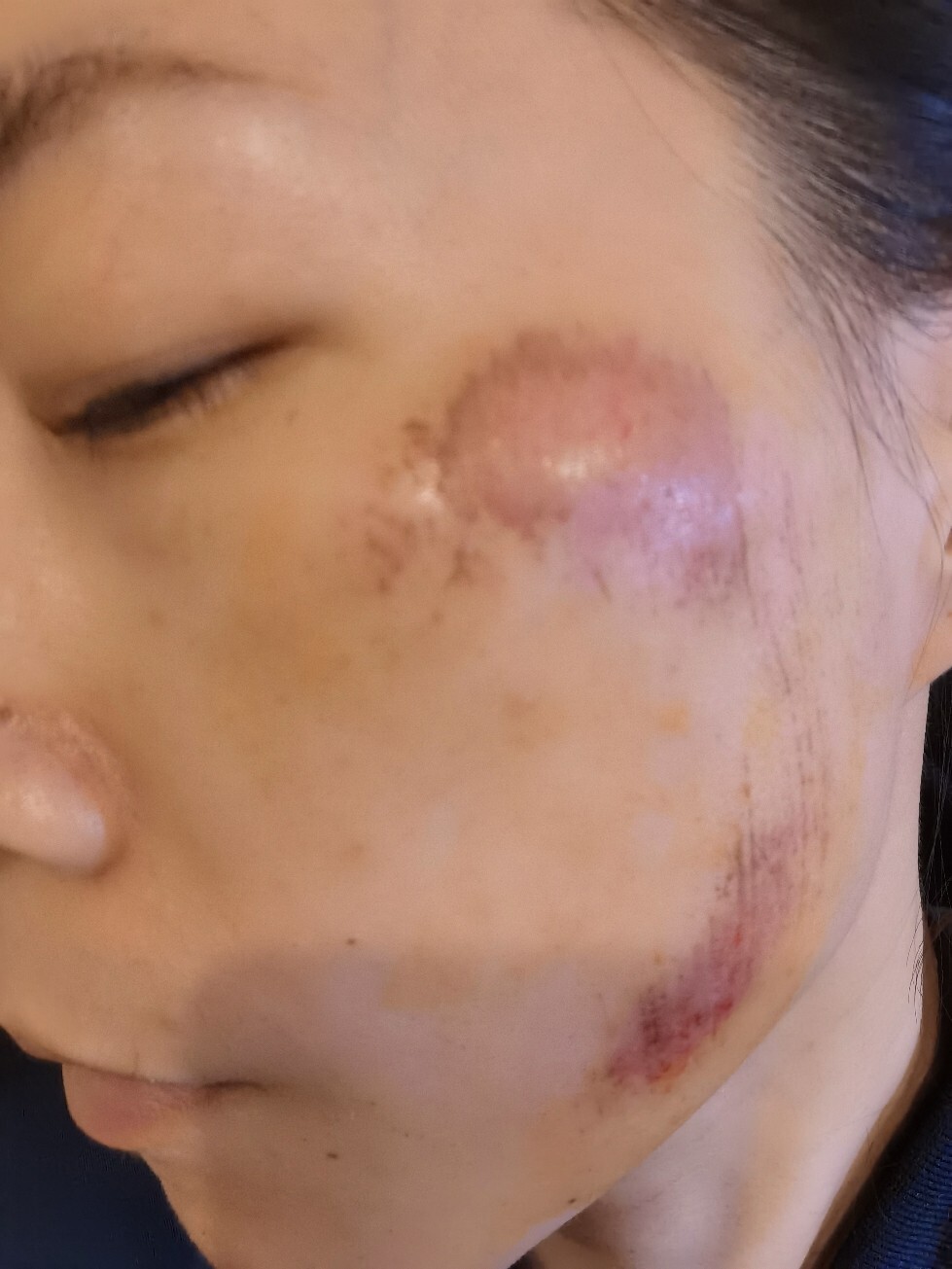 脸部擦伤后的恢复