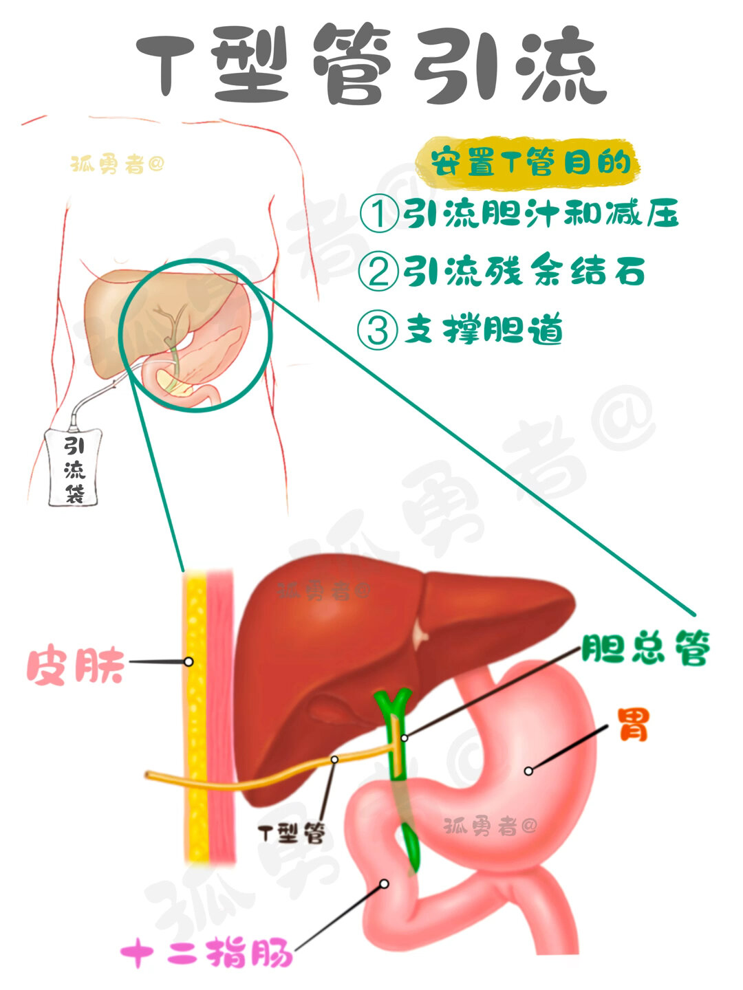 胆总管t型管拔管图图片