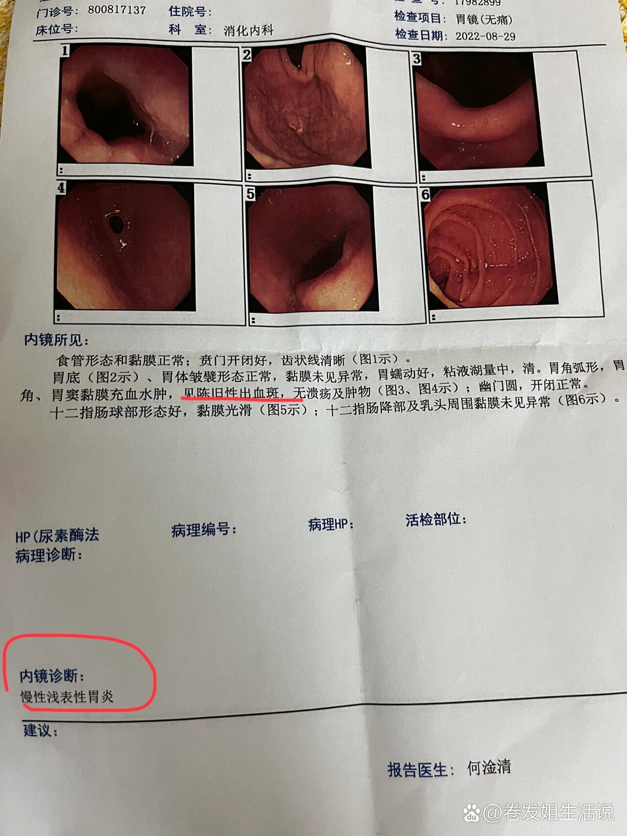 胆汁反流性胃炎到浅表性胃炎8年辛酸史