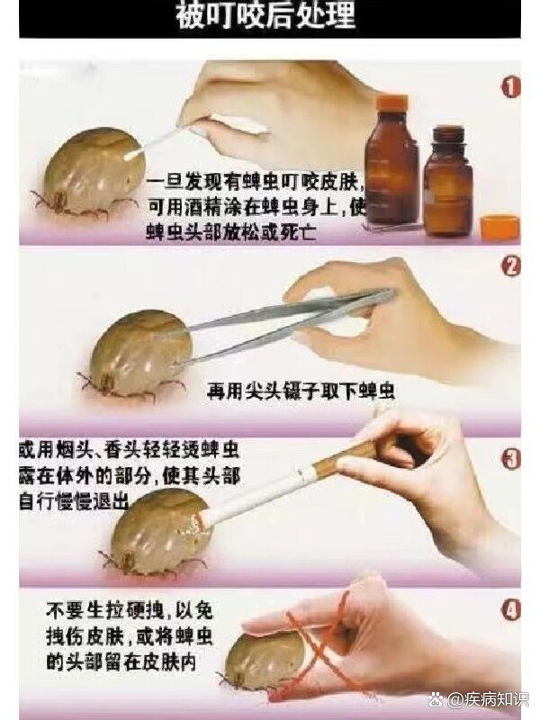 蜱虫怎么去除简单方法