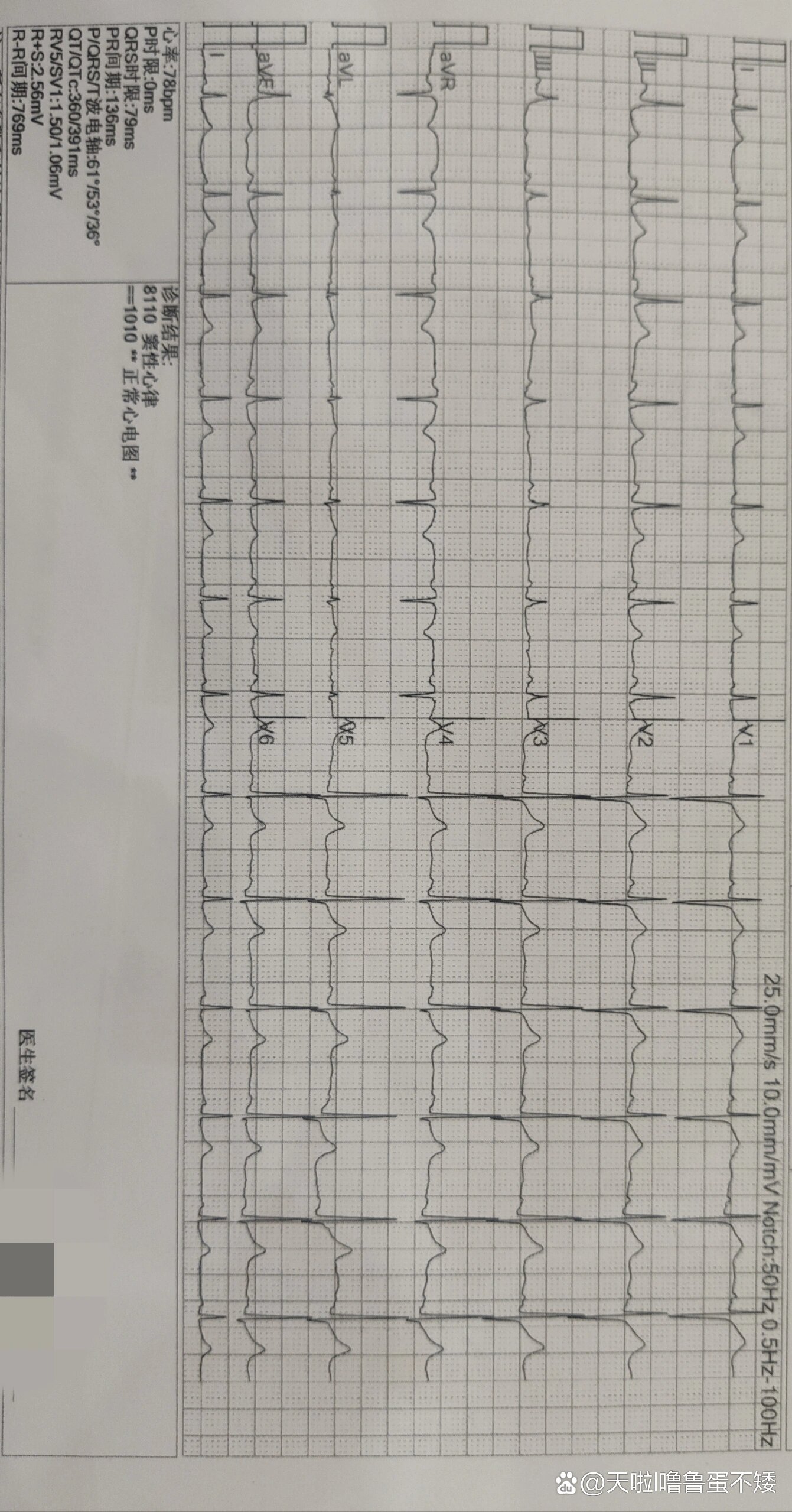 起搏器心律心电图报告图片