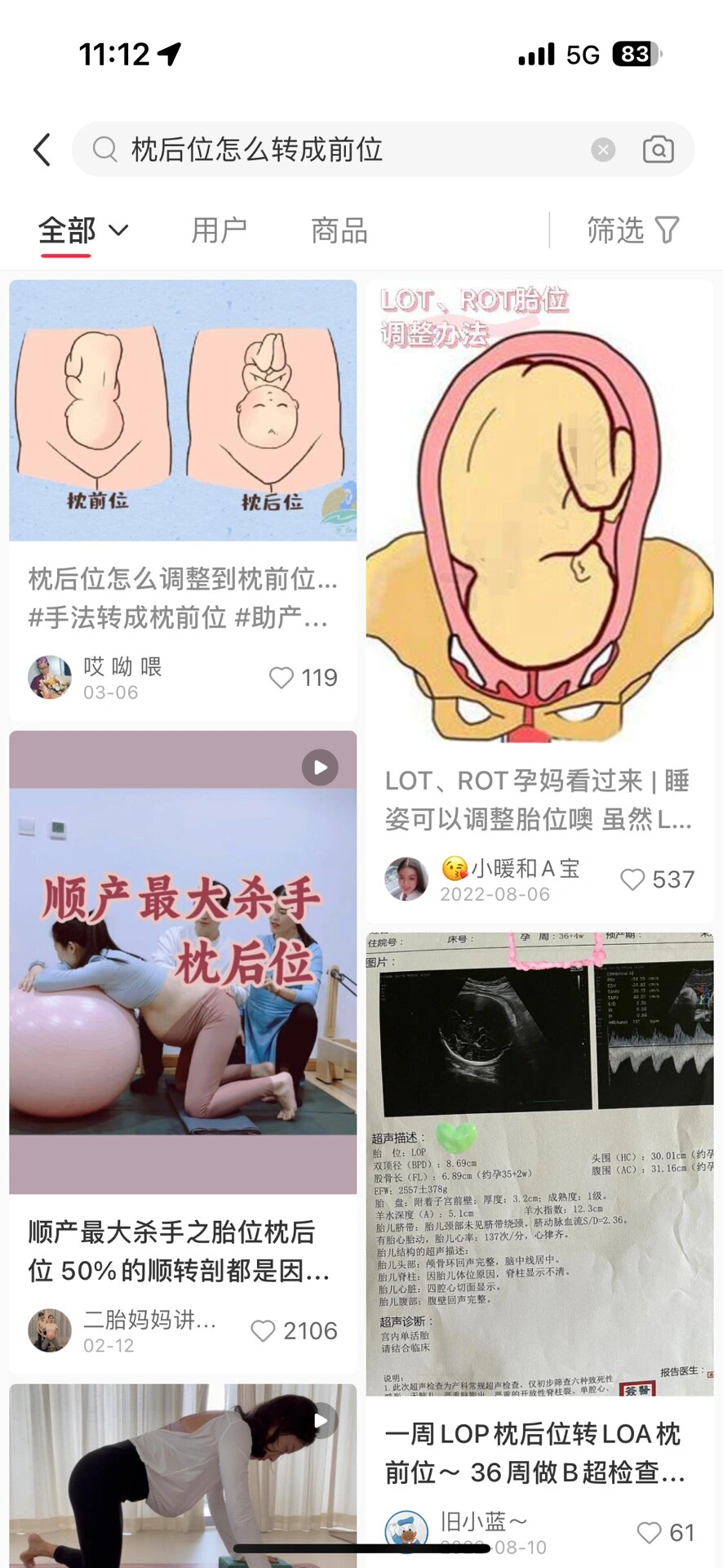 枕后位还能顺产吗