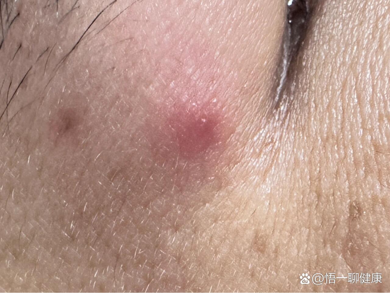 红肿大硬痘?大家有长过像这样的大痘痘吧!