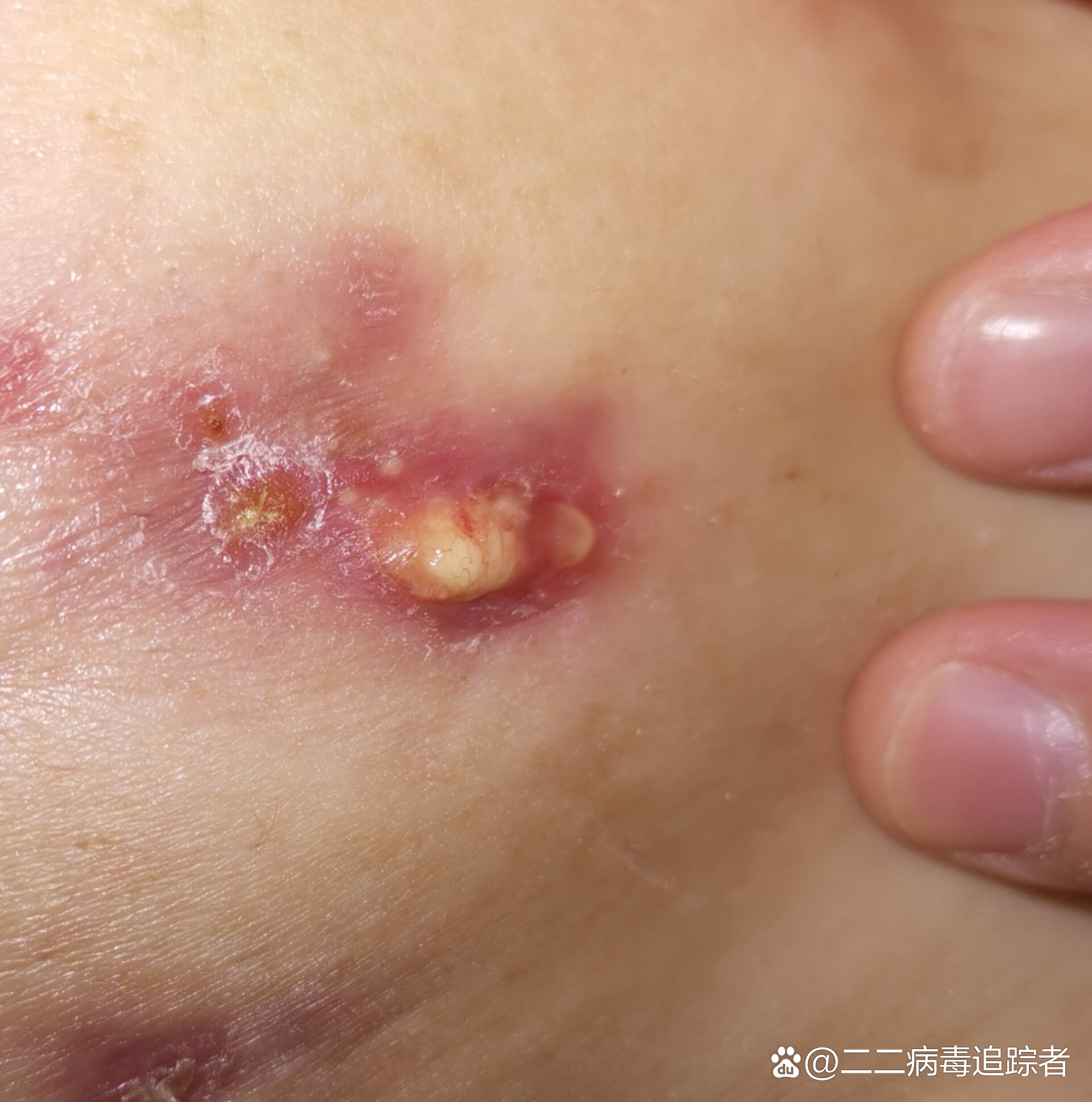 乳腺炎化脓破溃了