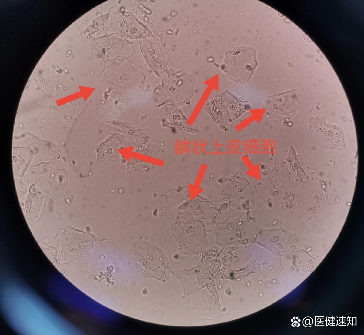 白带常规霉菌镜检图片图片