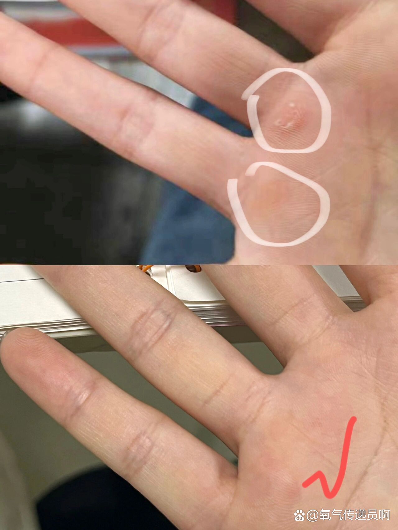 手上有茧的看这个去茧方法!