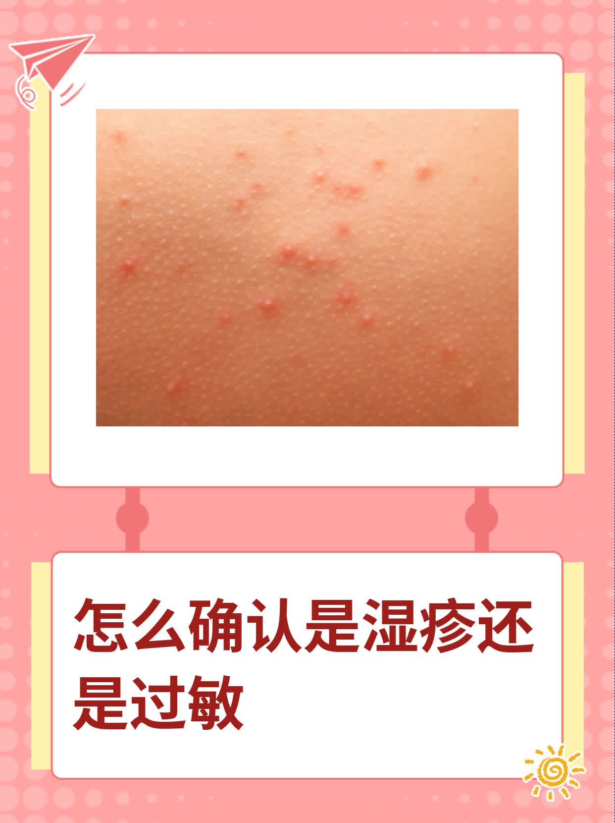 脸上为什么会有湿疹