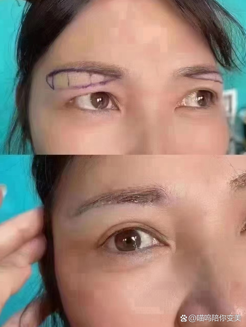 提眉手术前后对比照片及注意事项