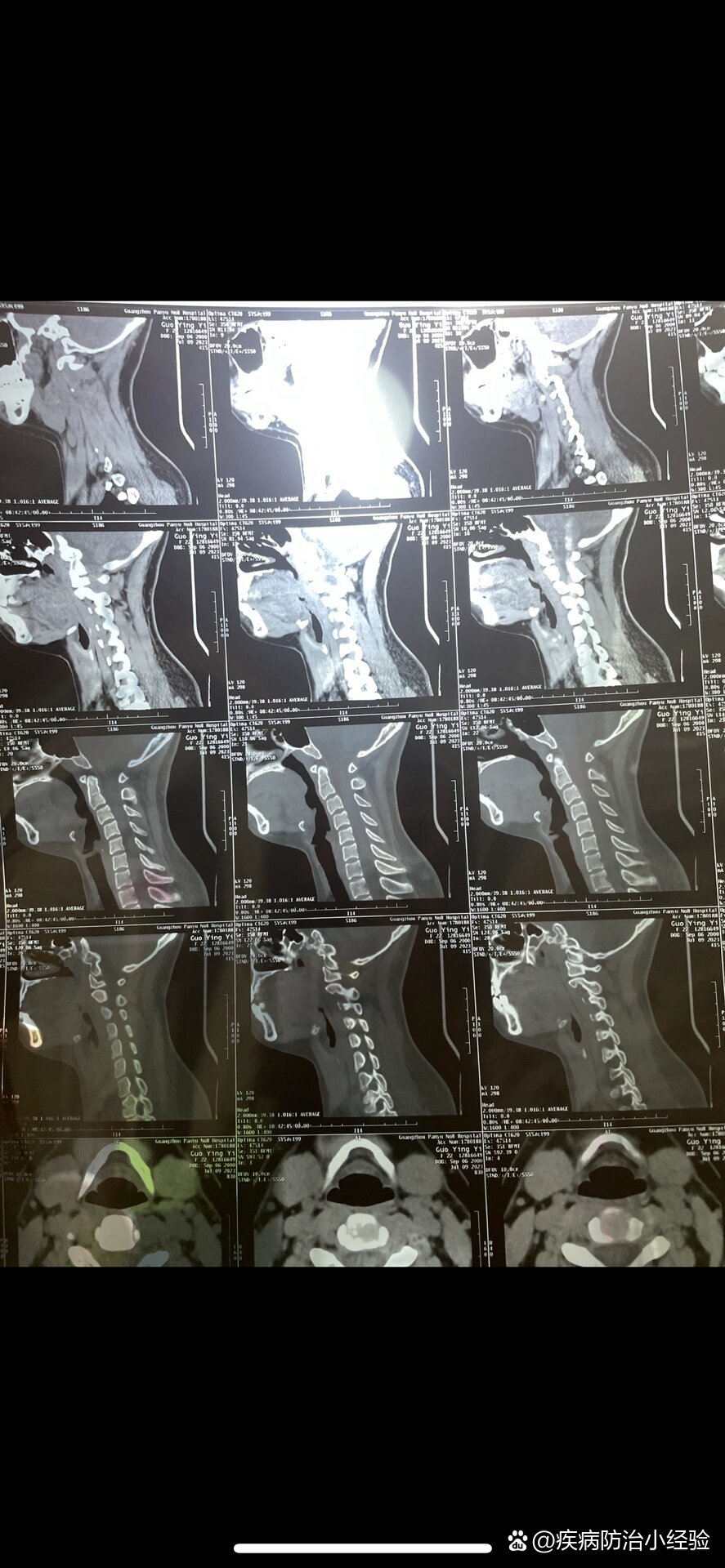 有时候看东西会突然有点模糊,去医院拍片子医生说我颈椎反弓,年纪轻轻