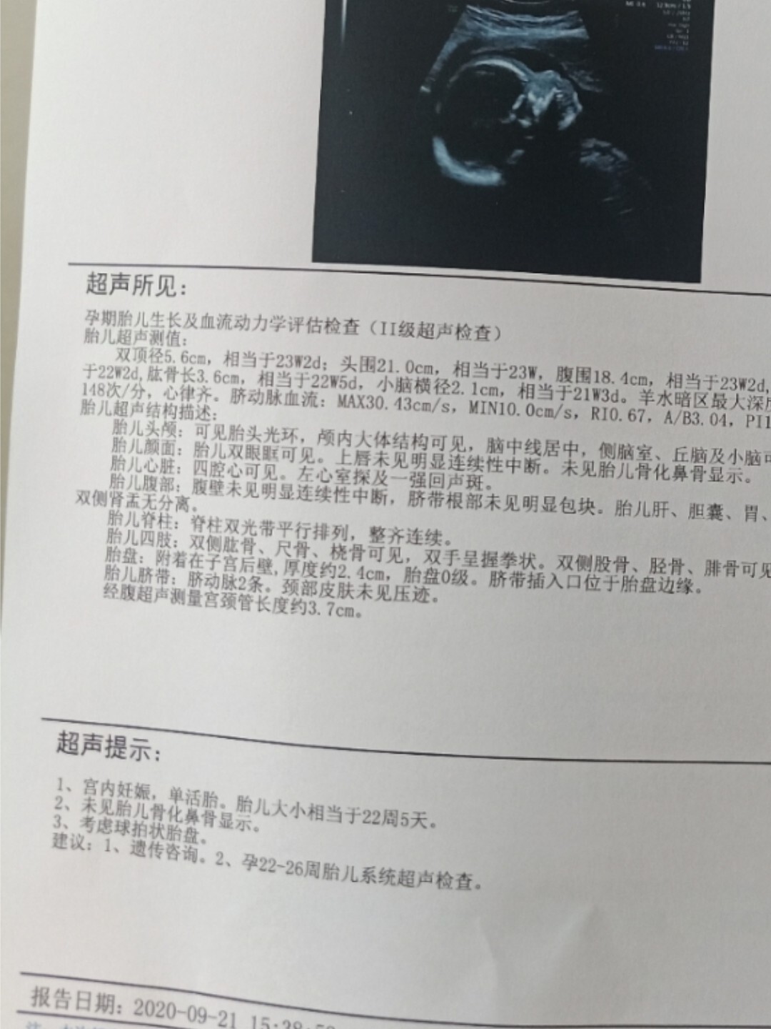 关于胎儿鼻骨显示不清