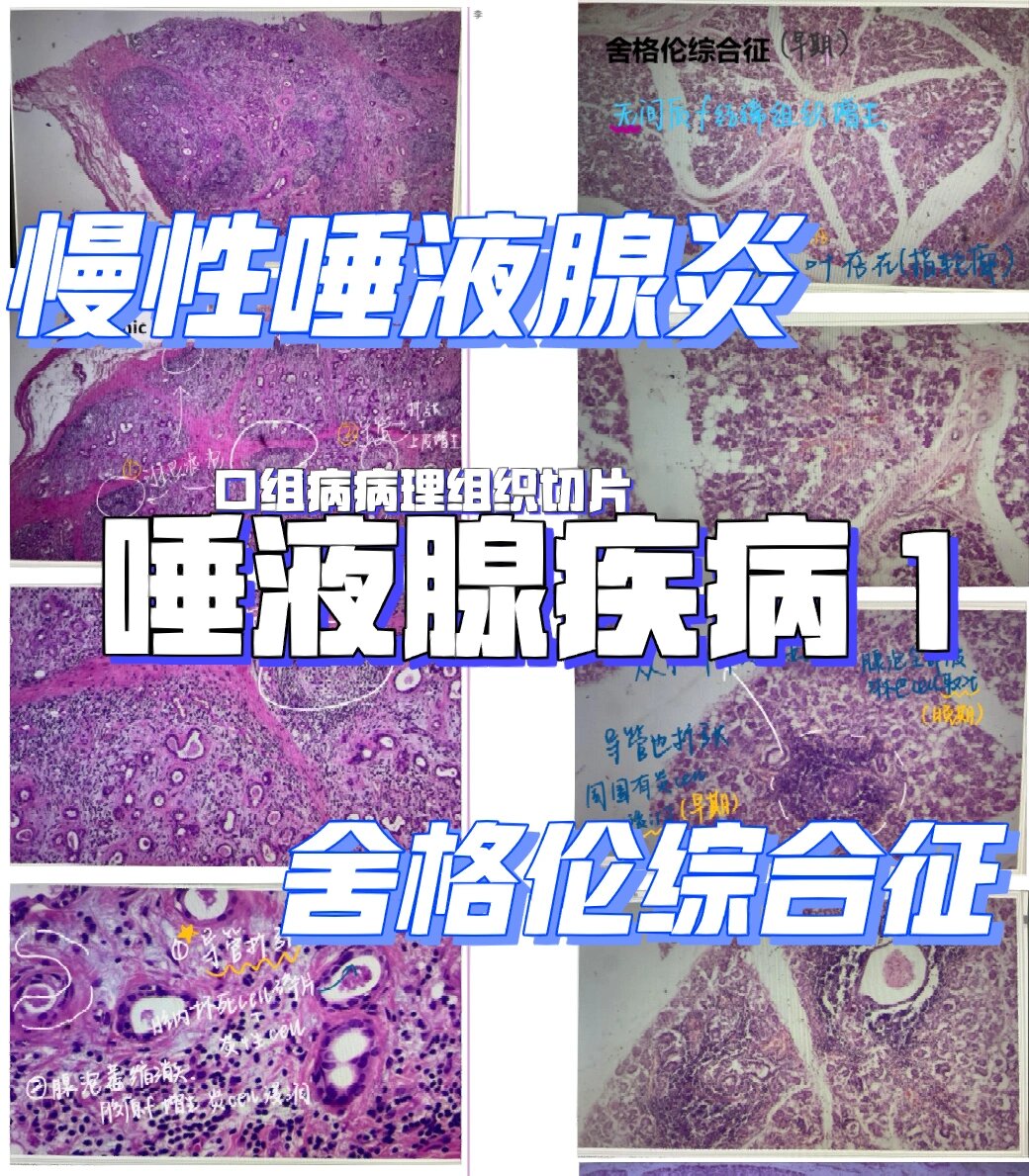  p>慢性唾液腺炎77舍格伦综合征 病理组织切片 br>唾液腺疾病 口腔