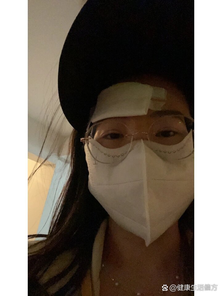 额头的皮脂腺囊肿(表皮样囊肿)终于切了