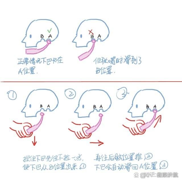 下巴脱臼怎么办自救图片