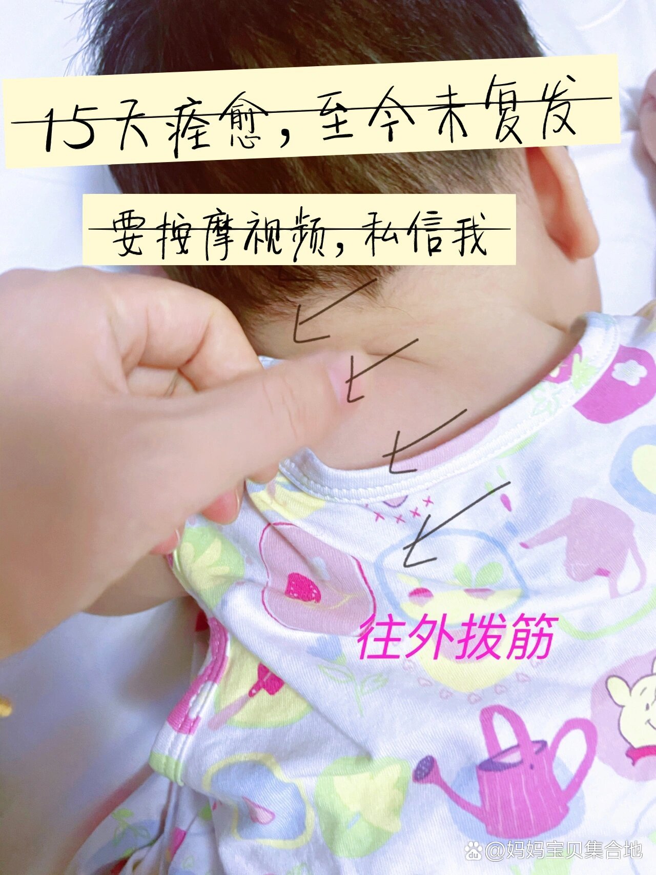 宝宝斜颈,半个月康复7015