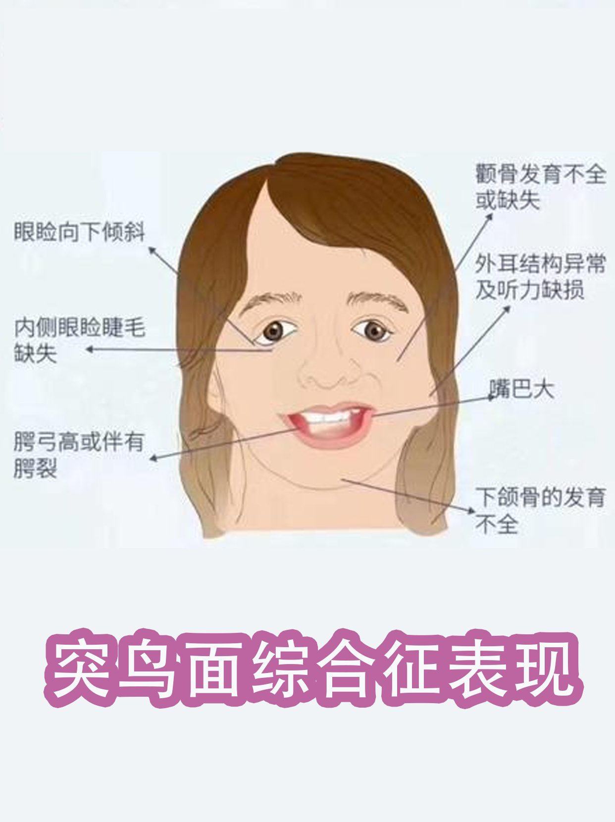 你不知道的遗传病,可怕的鸟面综合征